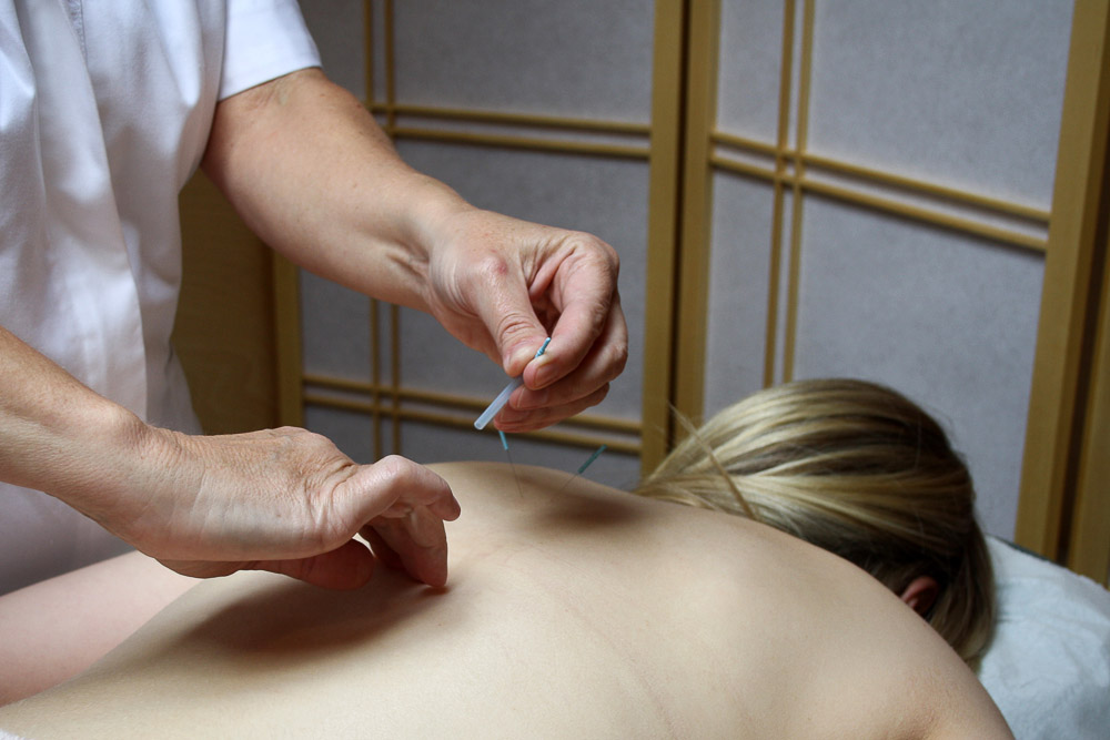 acupuncture +